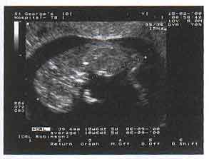 how accurate is a scan due date